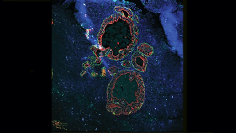 IOR paves the way for the clinical development of a therapy against prostate cancer metastasis