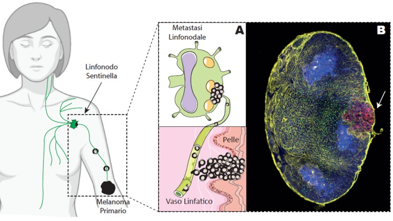 A) Representative model showing the spreading of melanoma cells from the skin to the sentinel lymph node. B) Microscopy image showing the metastasis of melanoma tumor cells (red color) in a lymph node.