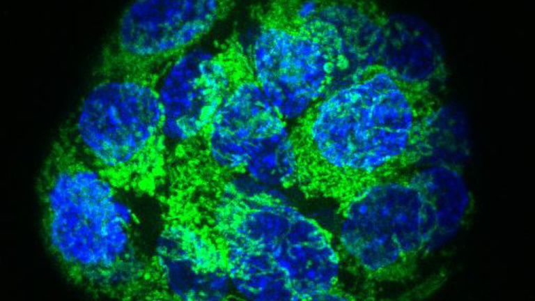 IOR study reveals new way to eliminate cancer stem cells in prostate cancer